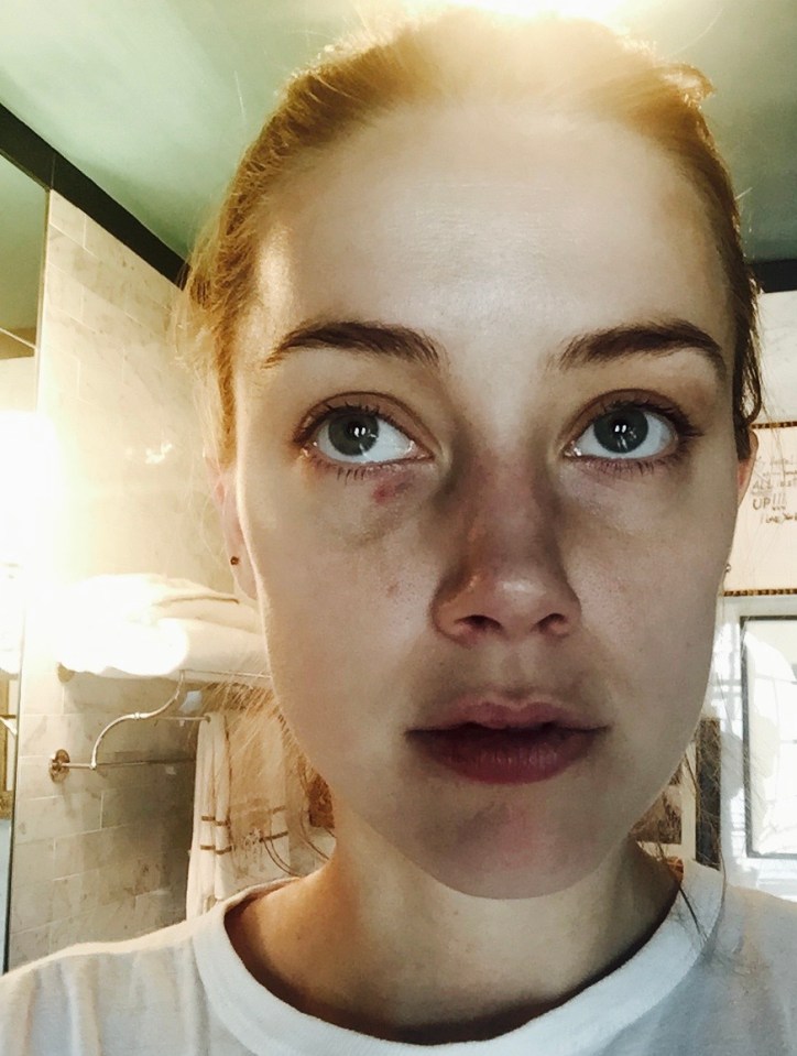 Amber Heard has alleged she was attacked by then husband Johnny Depp 14 times