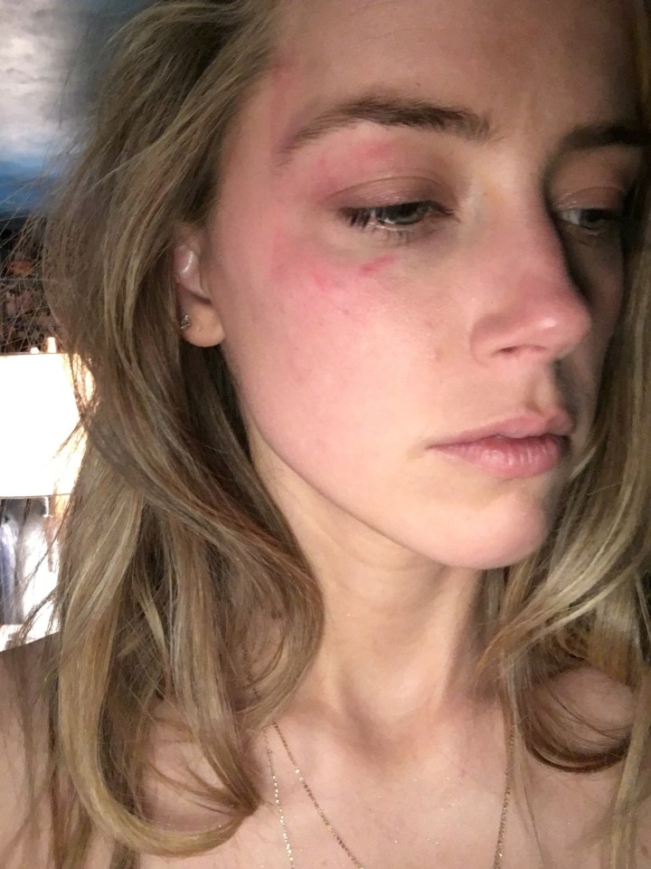 Amber Heard alleges she was left with a cut eye and bruises after the incident at their LA penthouse in May 2016