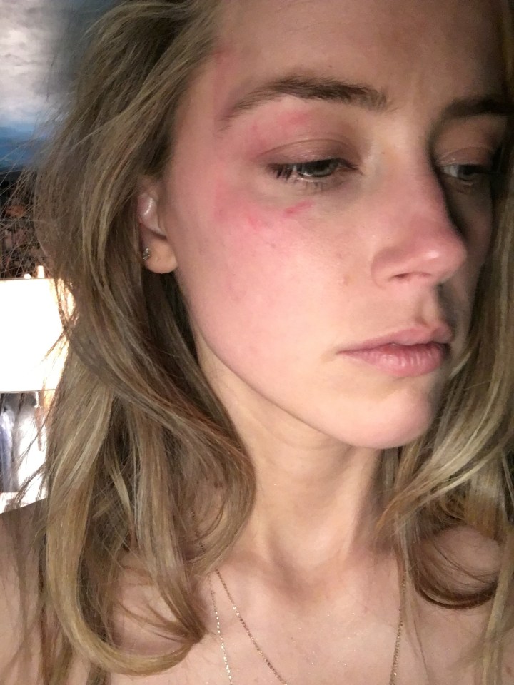 Amber Heard is seen with a bruised face after Johnny Depp allegedly threw a phone at her in May 2016