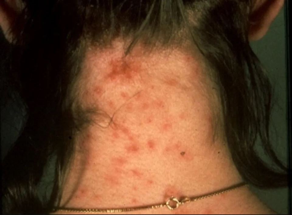 Head lice bites can be irritable