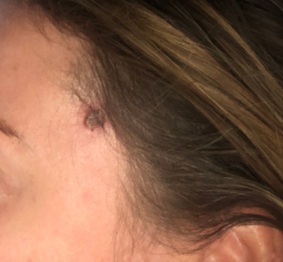 The beauty therapist developed a tiny scab - which she thought was bleach burn