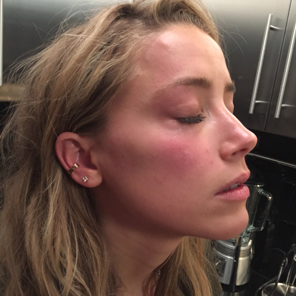 A new photo showing a bruised Amber was shown to the court