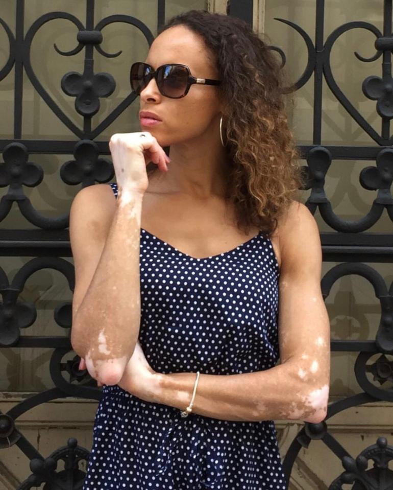 Natalie says she is proud of her vitiligo