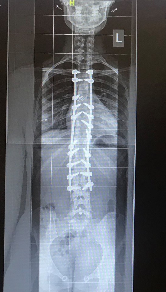 Megan's surgery was to straighten her spine with two metal rods