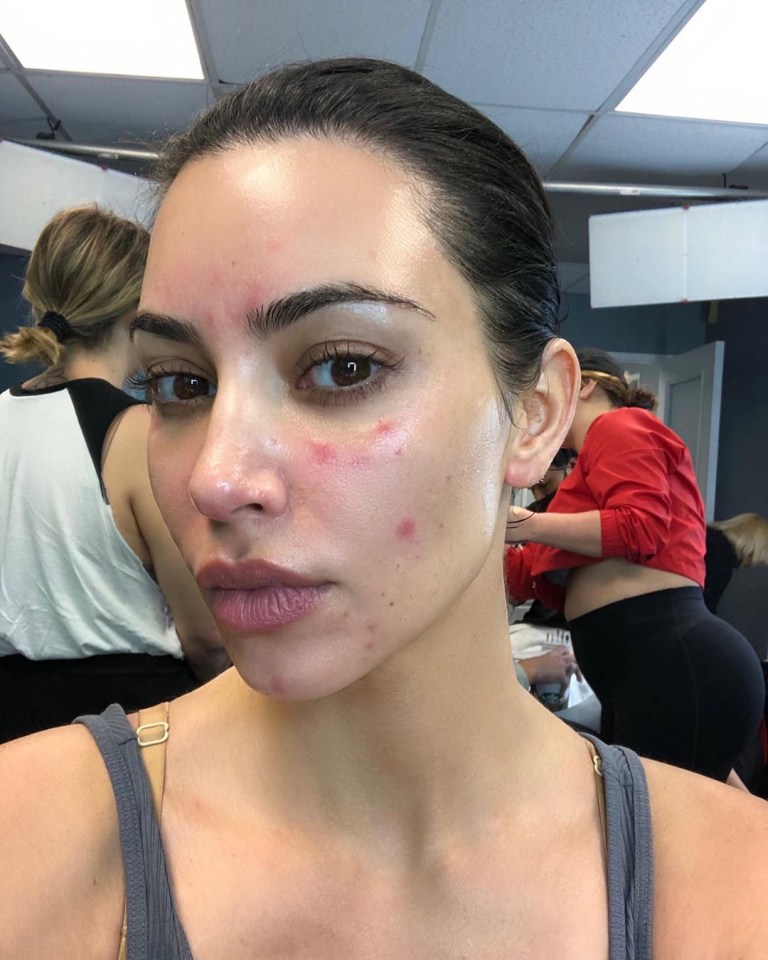 Kim Kardashian suffers from psoriasis - a condition that causes red, scaly patches