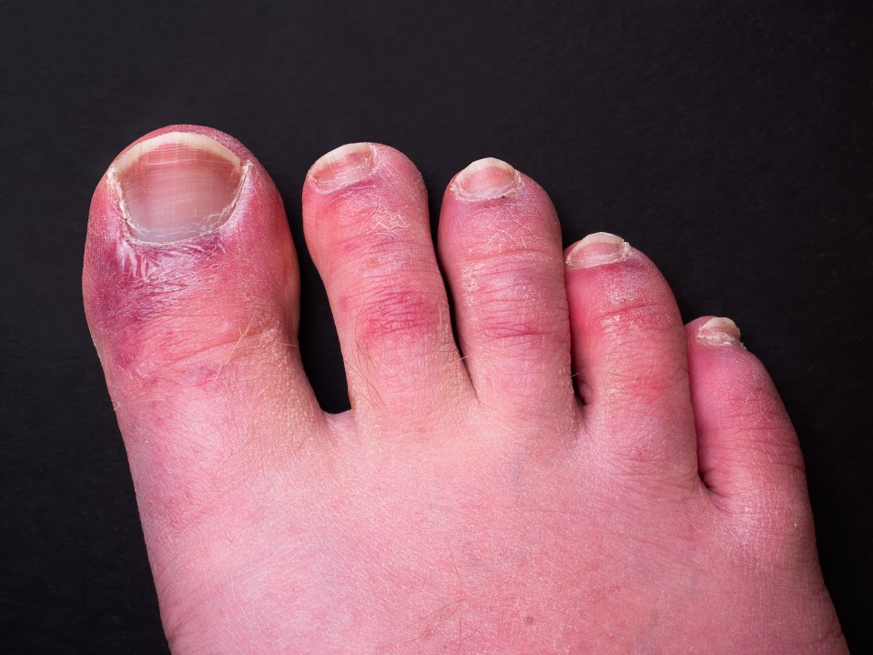 Some coronavirus patients have noticed chilblain-like lesions forming on the toes