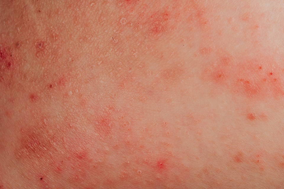 Eczema is one of the most common skin conditions and it causes dry, red and cracked skin