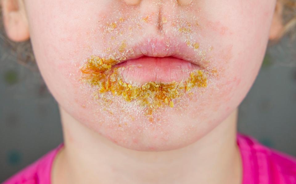 Impetigo normally starts on the hands or face but it can spread all over the body