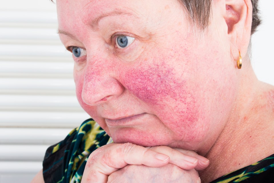 Rosacea isn't harmful but Dr Mayou advises seeing a doctor if it causes pustules