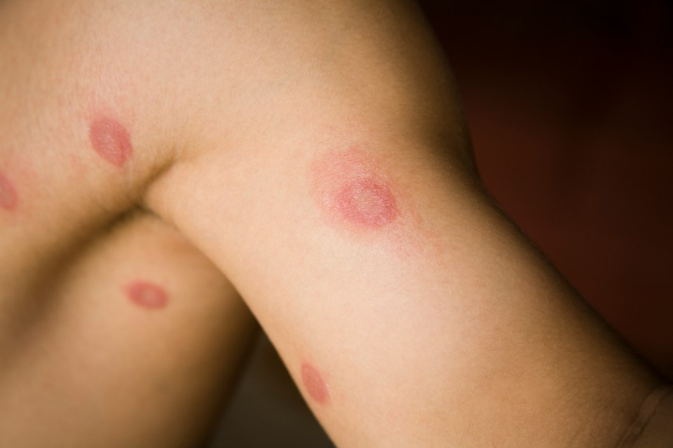 The appearance of ringworm is 'usually ring-shaped, unless it appears on the neck, face or scalp'