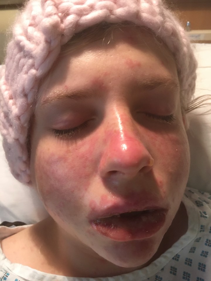 Bethan Paley thought she had been bit by insects before her symptoms got worsr