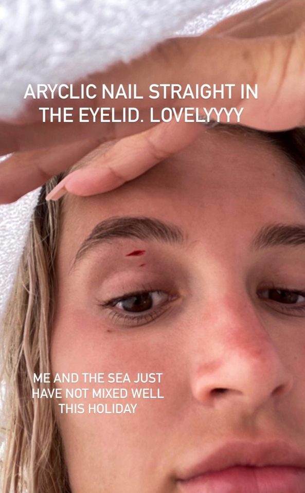  Molly-Mae Hague slashed her eyelid open with her nail