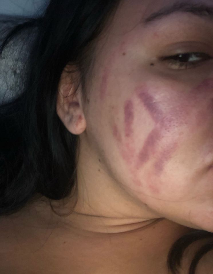 The 24-year-old student didn't leave the house for a week for fear of people thinking she'd been 'beaten up'