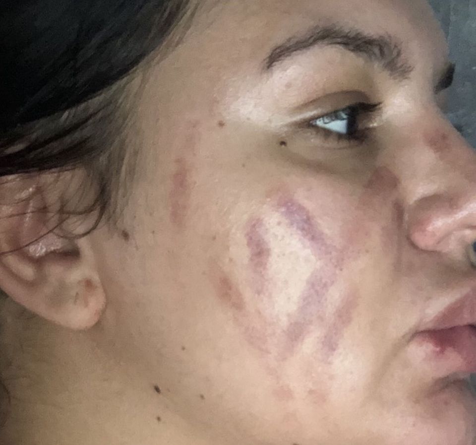 Safia was left with painful bruises all over her face after using the blackhead remover for just three minutes