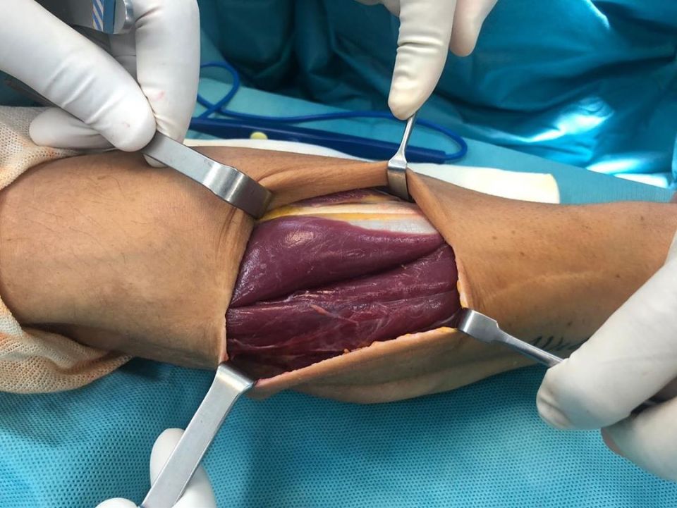 Viewers could see his arm muscle moving while the surgery was being performed