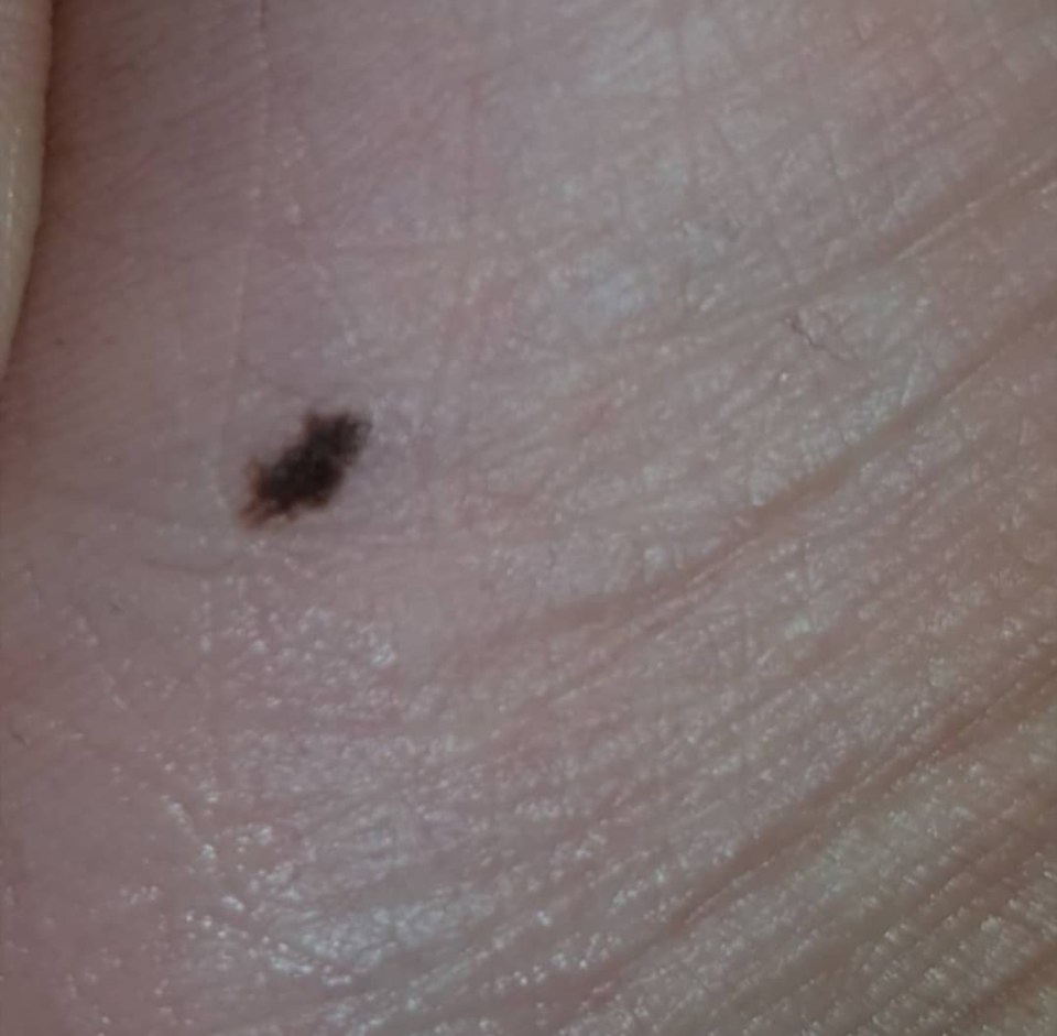 The cancerous mole on Sarah's foot can be seen above - moles that change in shape are a sign of skin cancer 