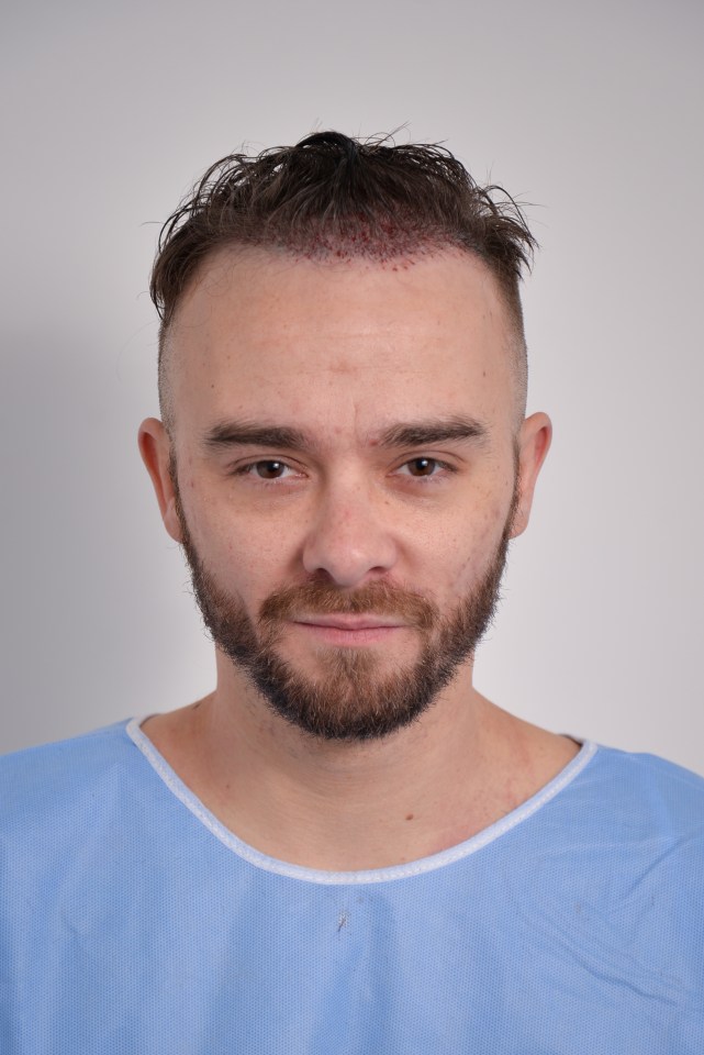 The Corrie actor undergoing his hair transplant