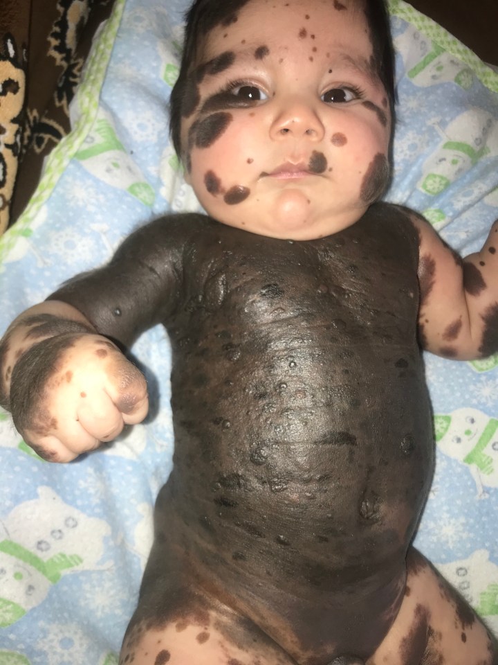 The youngster was born with nevus birthmarks on 80 per cent of his body