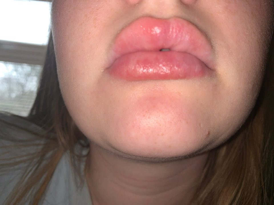 Soreness of the mouth or lips could be a type of rash related to Covid