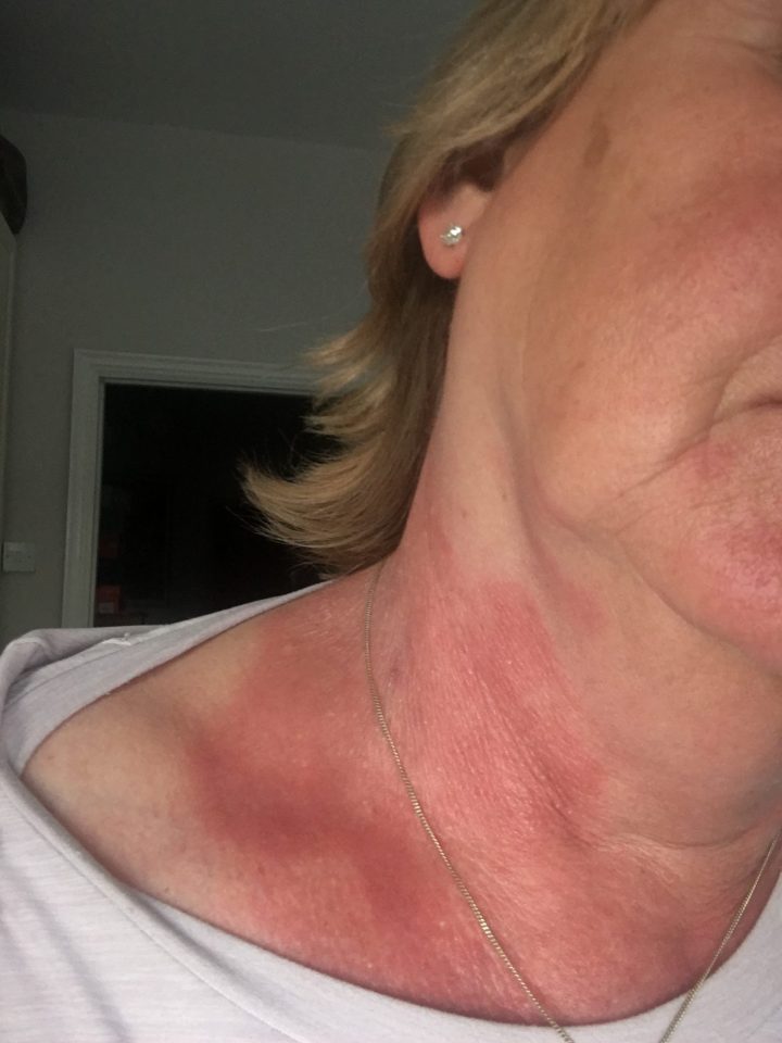 Eczema that appears across the neck or chest might be another sign of Covid