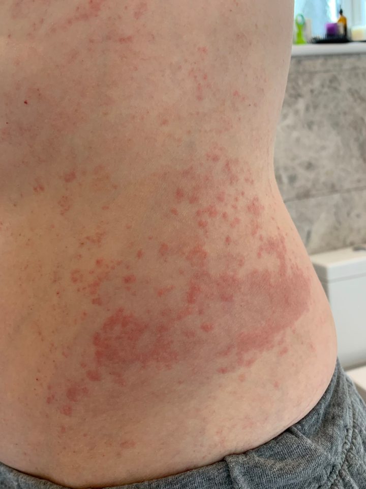 A 'prickly-heat' type of rash, known as a papular and vesicular rash, could also be a sign of Covid