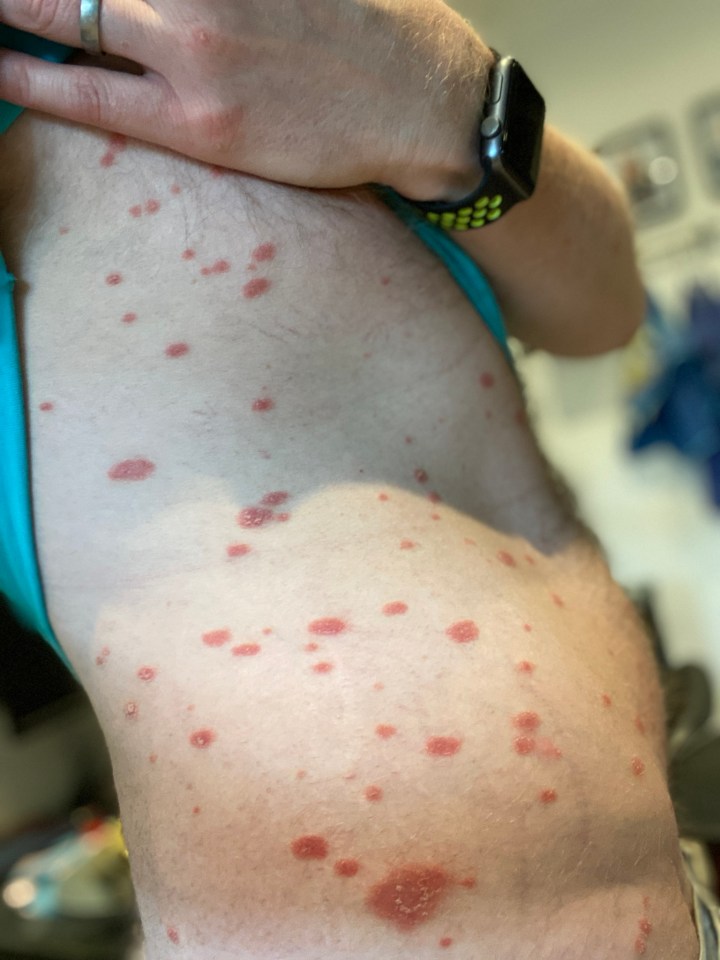 This type of rash is thought to be viral in origin but that's not been proven