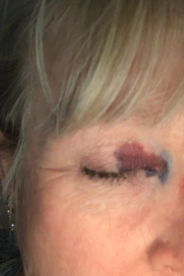 A woman with a purpuric rash in the corner of her eye