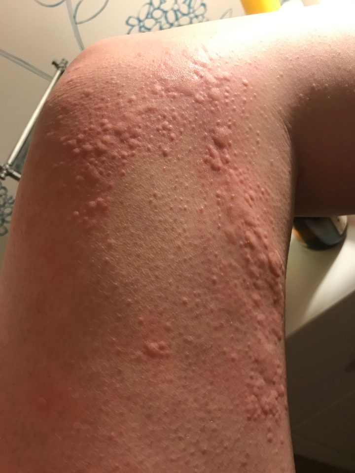 This rash appears as sudden raised hives or wheals on the skin which come and go quite quickly over hours and are usually intensely itchy