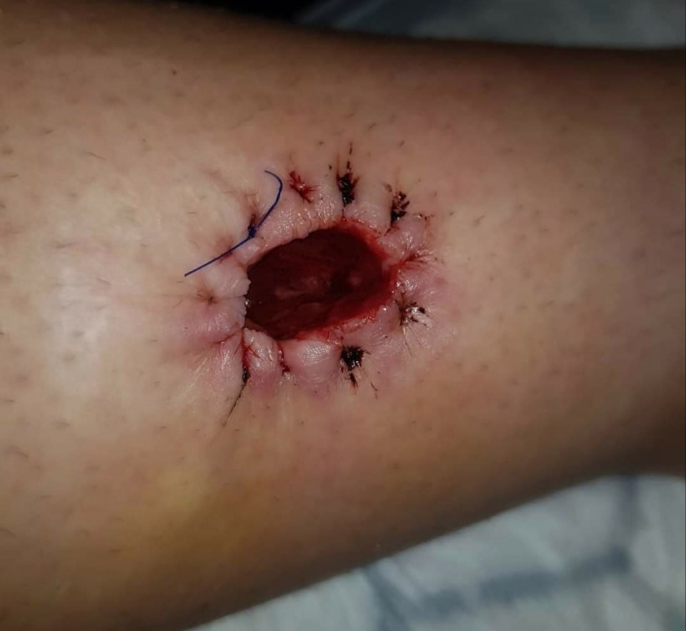 Sarah's leg is seen above after the mole was removed 