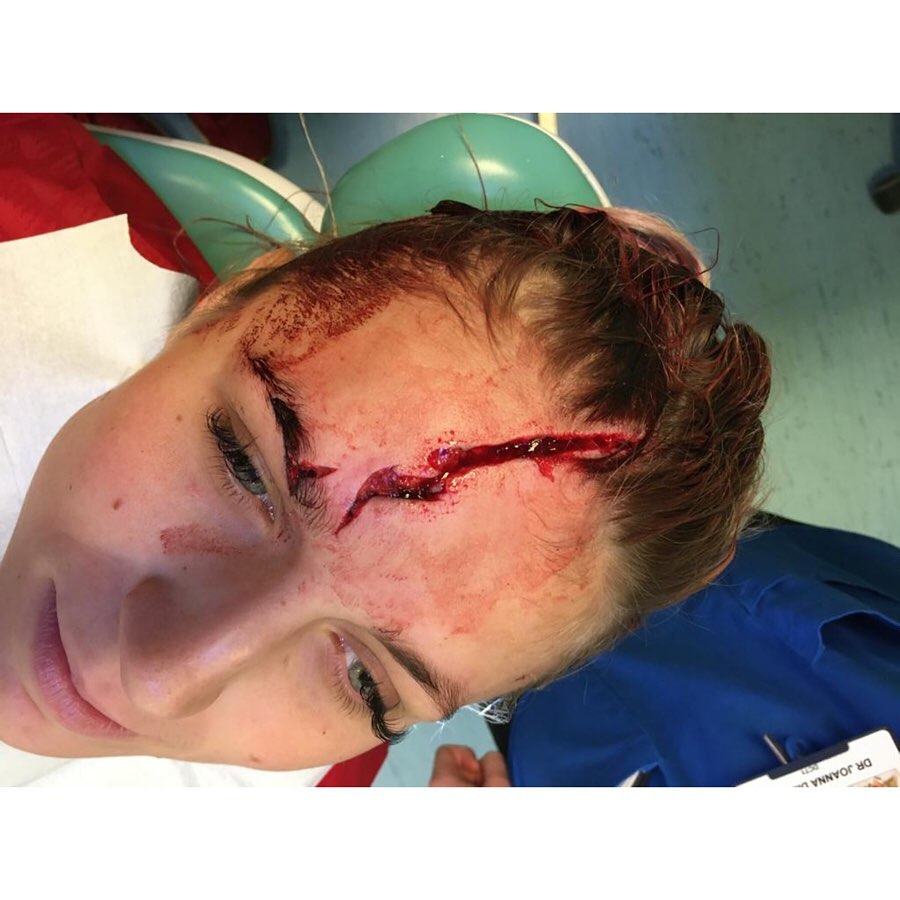 Liverpool keeper Fran Kitching sustained a gruesome head injury in january