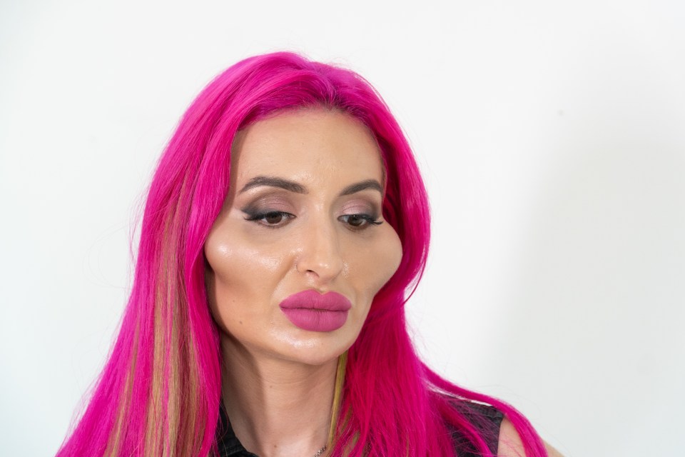 Anastasia injects her own cheeks with fillers