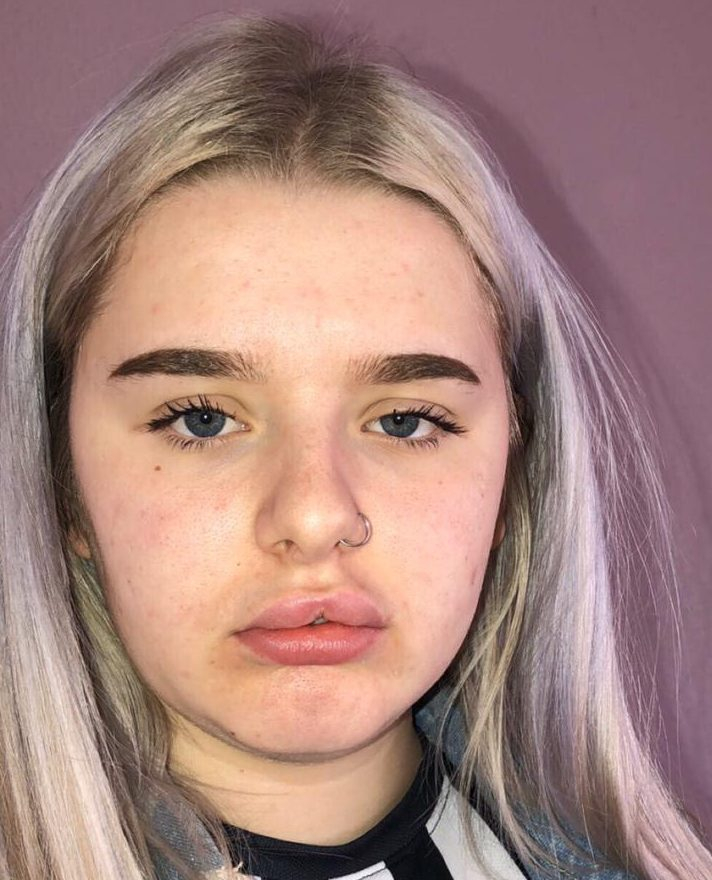  Anna Russell was just 17 when she decided to get lip fillers