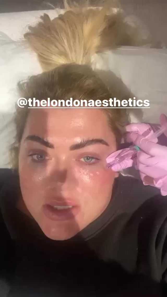 Gemma Collins has revealed she has had fat dissolved from her face