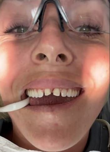 Ski legend Vonn shows off her teeth being ground down to make room for the veneers