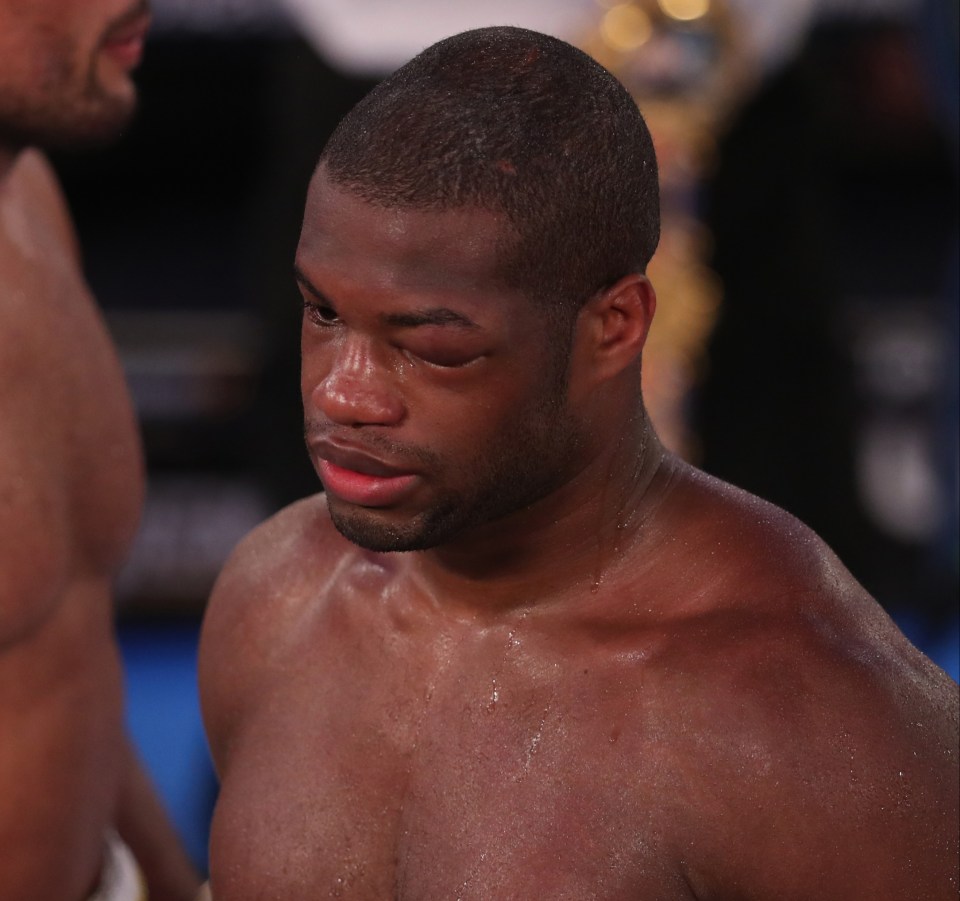 Dubois left eye was completely shut due to the damage taken