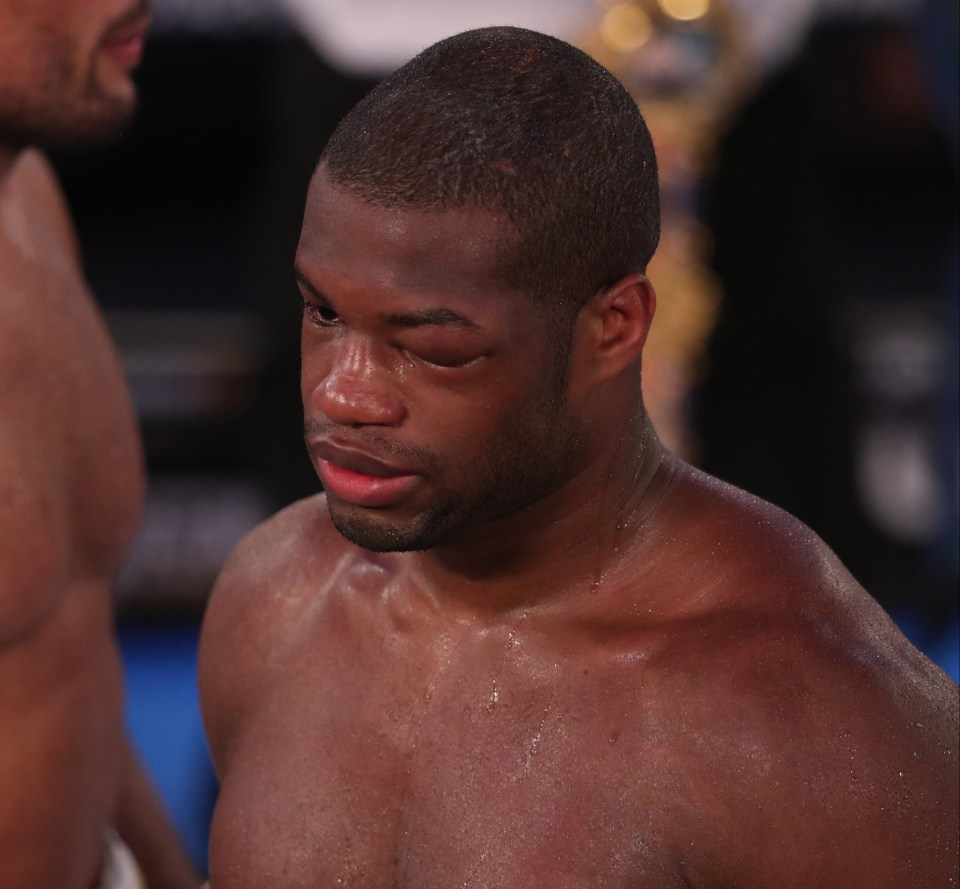 Dubois' eye was left completely shut after the loss 