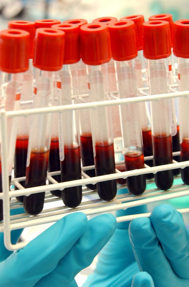 A blood test can detect Alzheimer's up to four years before symptoms