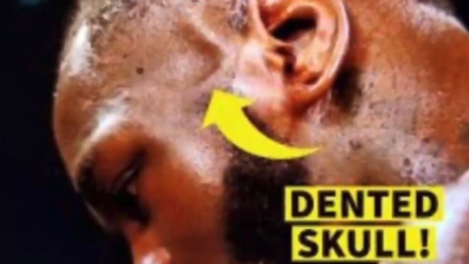 Deontay Wilder shared this snap in his video showing his 'dented skull'