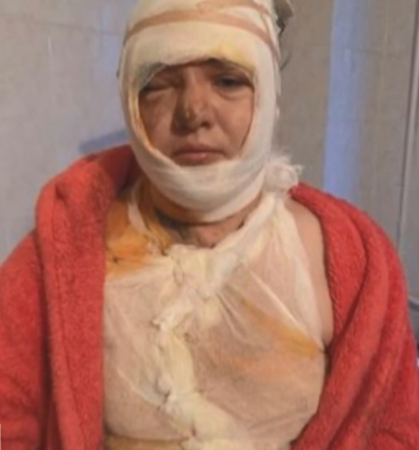 Valentina Pechka, 33, was doused in acid and has been left facially disfigured