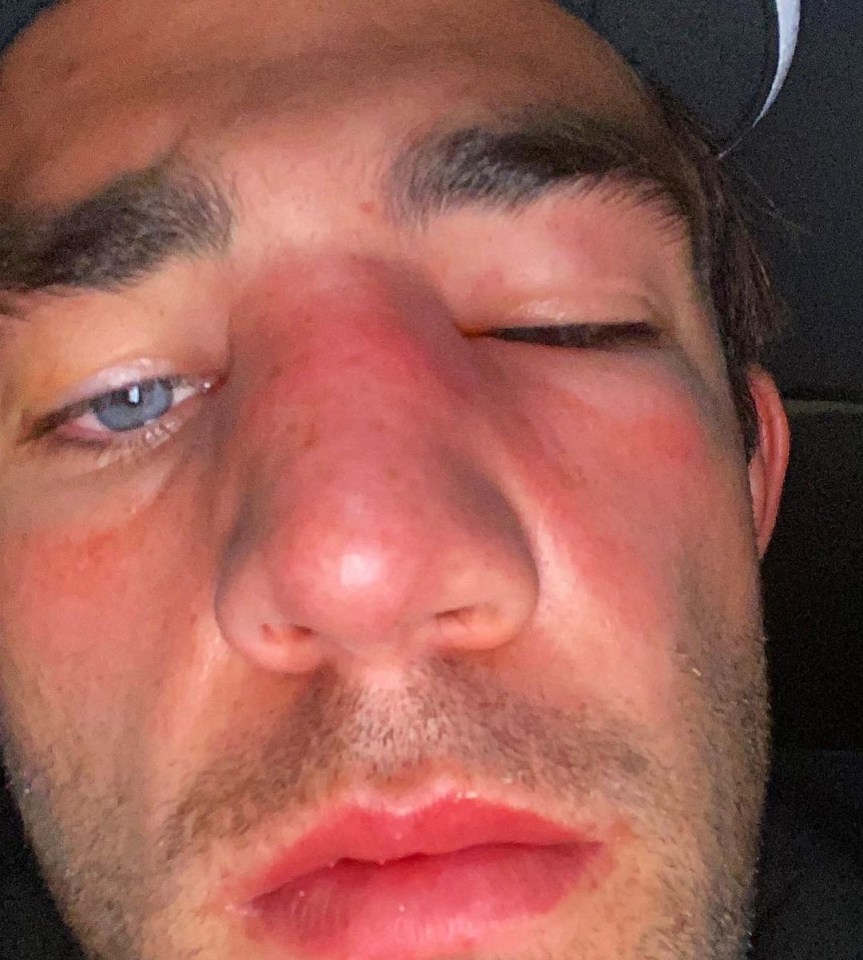 Love Island's Jack Fincham's broken nose has KO'd his big bout