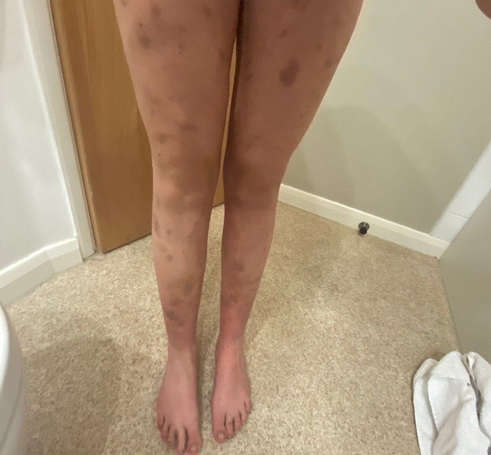 Maura said her legs were also covered in strange black marks