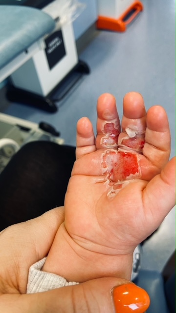 The £199 Shark DuoClean cleaner sucked up his hand, leaving him with a friction burn