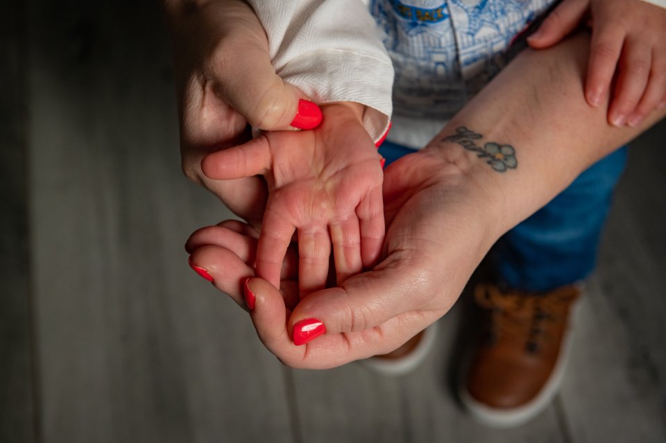 The toddler still has scars on his palm from the horrific accident