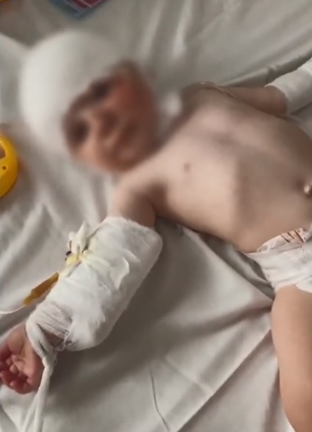 The 10-month-old was left fighting for her life with shocking burns