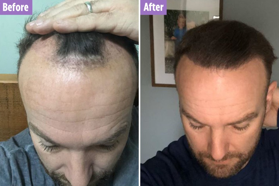 The star decided to get a hair transplant after years of anxiety about balding