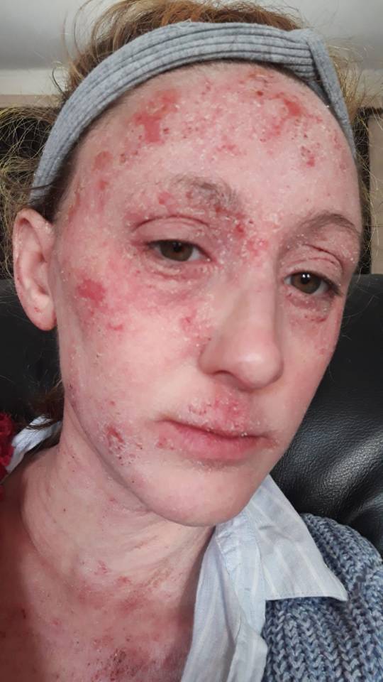 Showing her damaged skin after using steroid cream