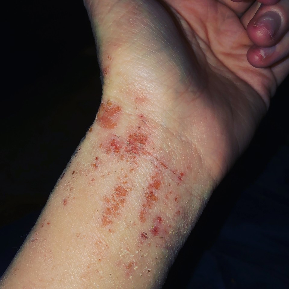 The eczema spread to her hands and wrists