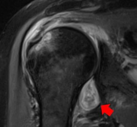 MRI image of a patient's shoulder. The red arrow points to inflammation in the joint. Covid-19 triggered rheumatoid arthritis in this patient with prolonged shoulder pain after other Covid symptoms stopped