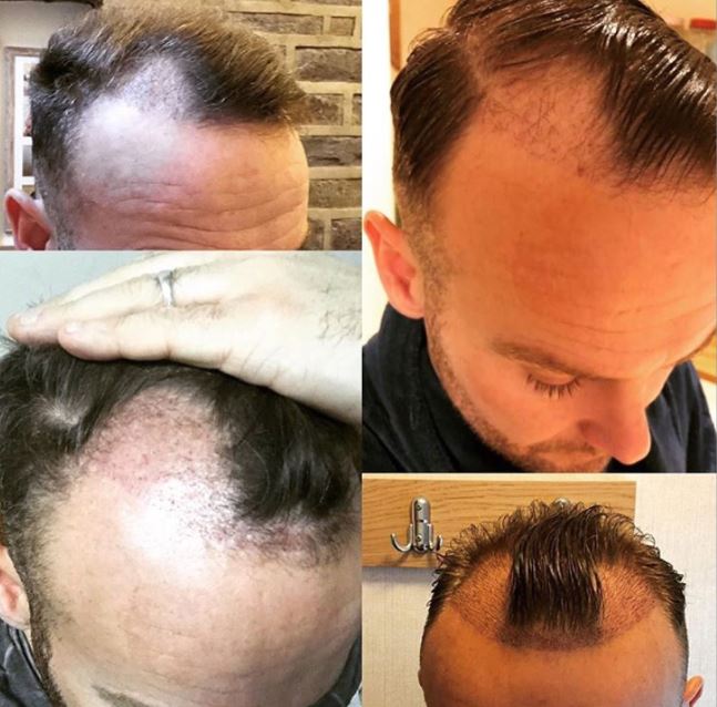 Kevin posted pictures of his bald patches on Instagram