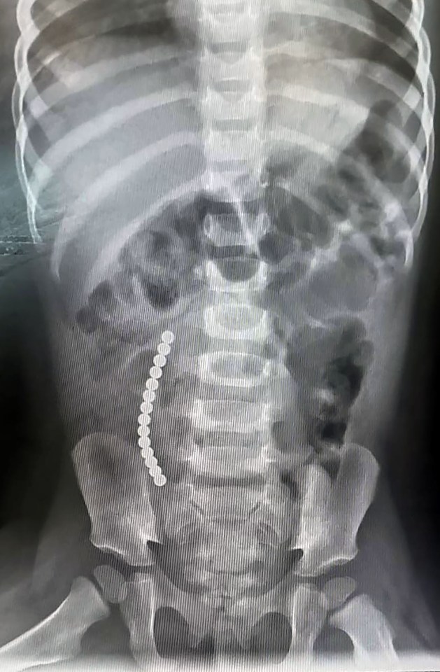 Medics were puzzled by Becca's condition - before an X-ray revealed the magnets 